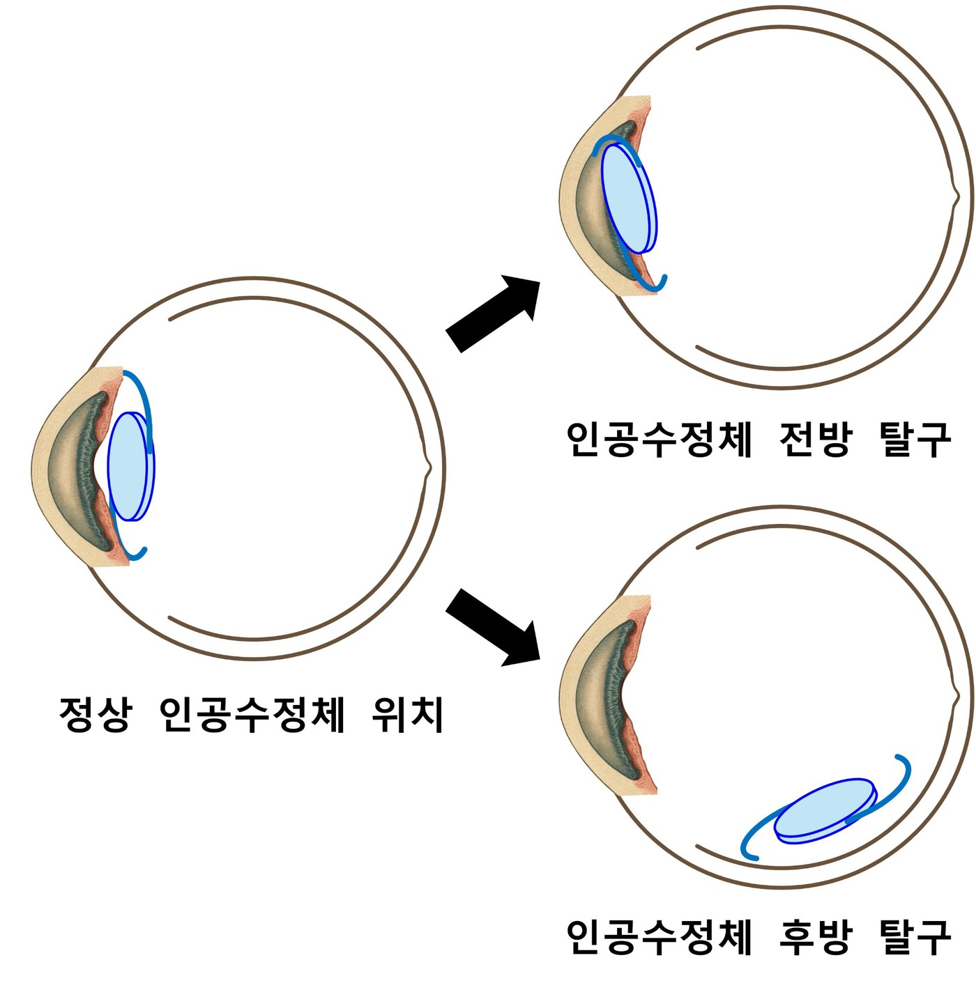 정상 인공수정체 위치와 전방 탈구 및 후방 탈구를 설명하는 도식